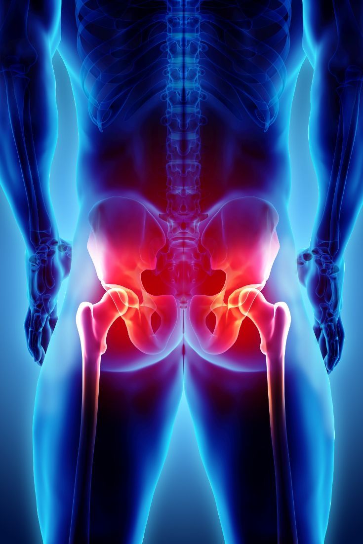 Ilustração 3D da articulação do quadril com inflamação — ortopedia